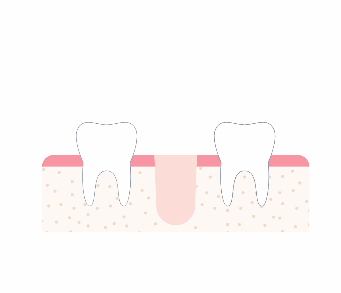 implant_anim